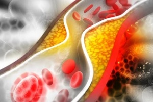 blood vessel blocked with cholesterol needing a Cholesterol Test