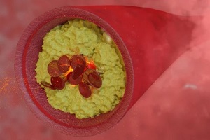 cholesterol deposit in arteries