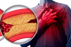 clogged arteries leads to heart attack