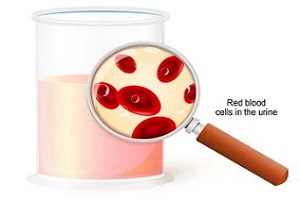 hematuria concept