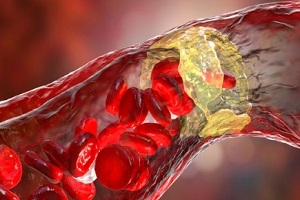 artery blocked due to cholestrol