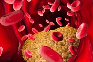 triglyceride deposited in blood vessel