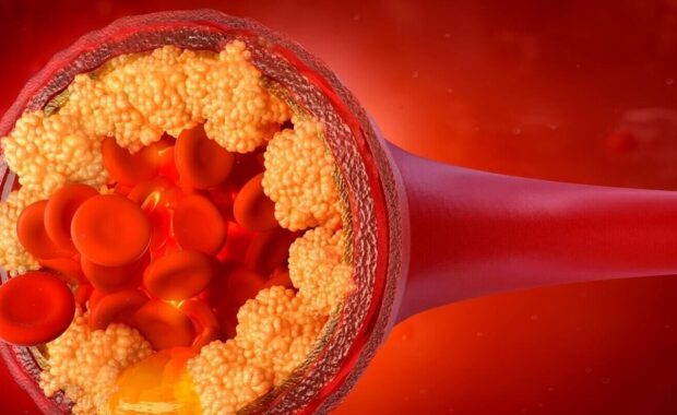cholesterol in the blood vessels
