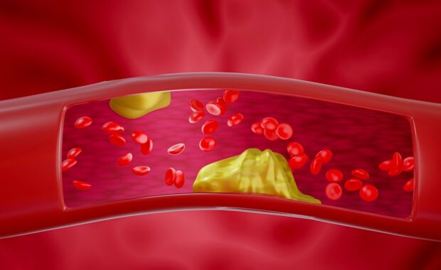 medical simulation Blood clots or fat clots in the blood vessels