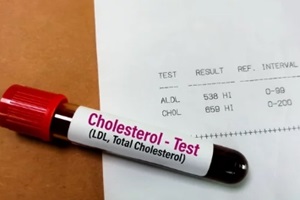 sample for ldl cholesterol test from NC resident