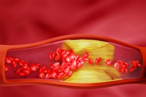 cholesterol depositing in a blood vessel