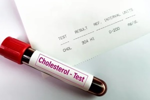 blood sample with abnormal high report of high Cholesterol test