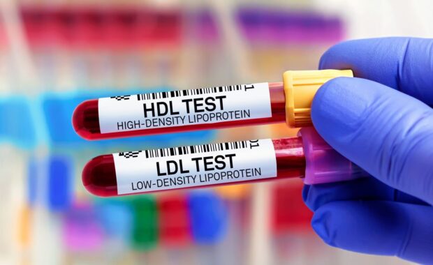 NC doctor with Blood tubes for HDL High Density Lipoprotein and LDL Low Density Lipoprotein test
