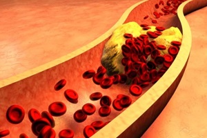 clogged artery with platelets and cholesterol plaque