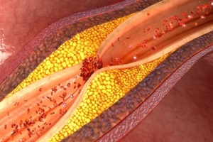 coronary artery plaque showing high cholesterol 
