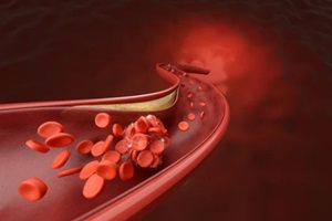 coronary artery and blood clot disease