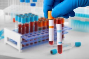 Cholesterol Screening Blood Sample