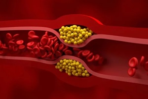 partly blocked vessel in high level of LDL