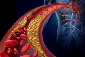 cholestrol deposited in a blood vessel