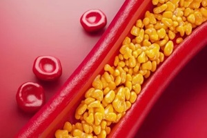 3D rendering of an artery showing plaque buildup