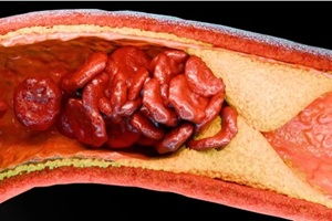 artery blocked with cholestrol