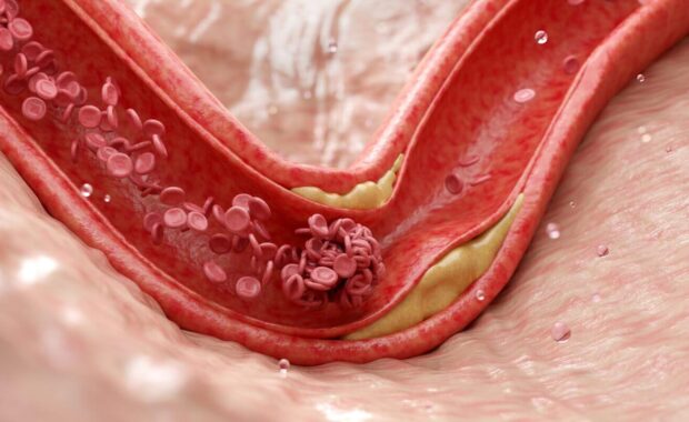 atherosclerosis arteries narrowed by plaque buildup causing heart disease from mixed hyperlipidemia