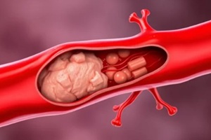 atherosclerotic blood vessel with plaque and high cholesterol and triglycerides