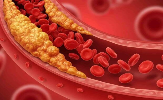 Cholesterol Plaque Obstructing Blood Flow in Artery causing mixed hyperlipidemia