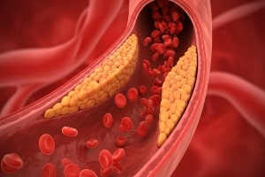 Mixed Hyperlipidemia Buildup Restricting Blood Flow in Artery