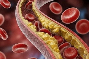 cholestrol desopited in the blood vessels