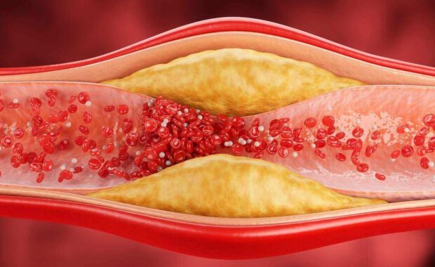 illustration of narrowed blood vessel due to atherosclerosis, Symptoms of high cholesterol in the blood