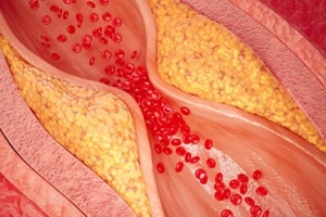 3d illustration of narrowed blood vessel due to atherosclerosis, Symptoms of high cholesterol in the blood