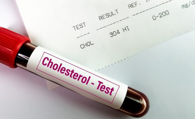 blood sample with abnormal high report of cholesterol test