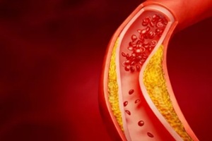 cholestrol deposited in the blood vessel