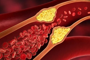 cholesterol deposited in blood vessels