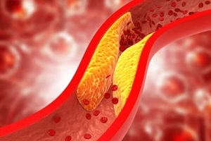 clogged arteries, cholesterol plaque in artery