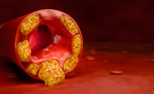 locked artery concept and human blood vessel as a disease with cholesterol fat buildup clogging