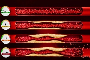high cholesterol risk gauge, artery blockage and rupture indicator
