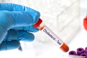 cholesterol test to look for abnormalities from blood