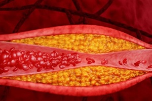 hyperlipidemia or arteriosclerosis